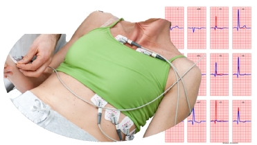 Figure 1 Practical example of misplacements of ECG electrodes with females. In the right panel an example of the ECGs at standard 12 lead ECG positions in blue and at the shown ECG positions in red as simulated by free educational package ECGsim [2] (www.ecgsim.org).