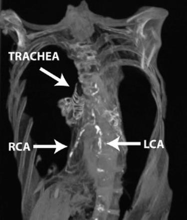 CT scan shows atherosclerosis in the coronary arteries of Egyptian Mummy