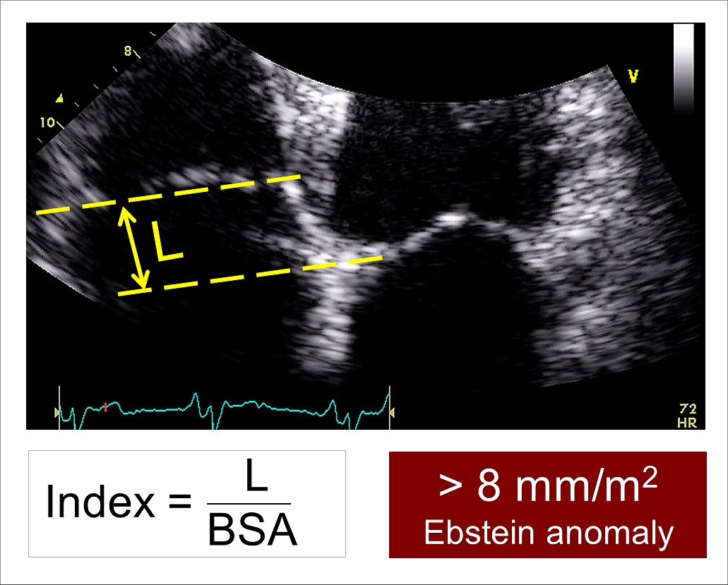 Anatomy of tricuspid valve